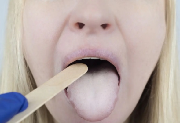 Jakie płyny do płukania jamy ustnej pogarszają stan pleśniawek?